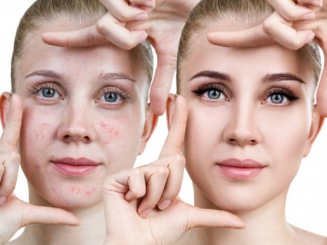 Kako se rešiti akni na licu?